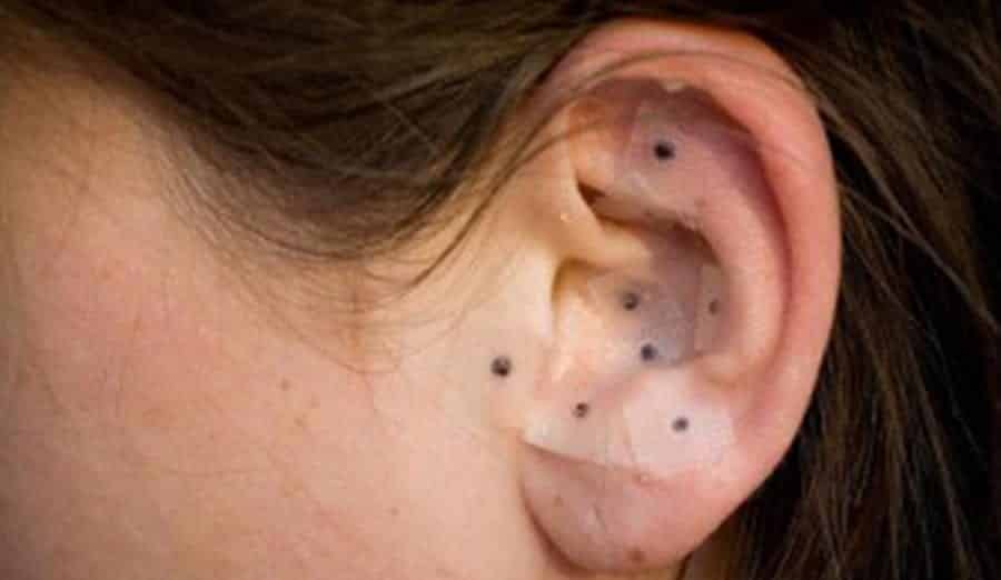 Auricular Therapy
