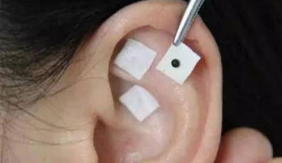 Auricular Therapy